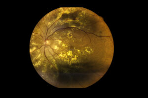 View inside human eye disorders showing retina, optic nerve and macula Severe age-related macular degeneration.Medical image Retina Abnormal isolated on black background